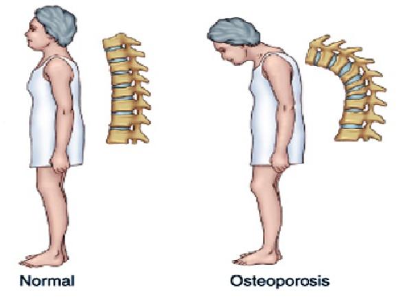 Come inizia la menopausa - Post-menopausa