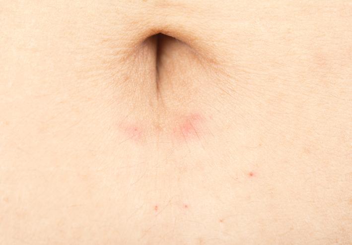 Perché mi prude e puzza l'ombelico? Cause e SOLUZIONI