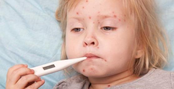 Come evitare il contagio della varicella