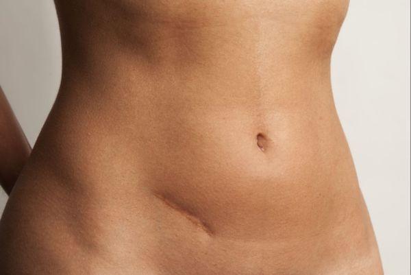 Dolore al basso ventre: cause e rimedi - Appendicite