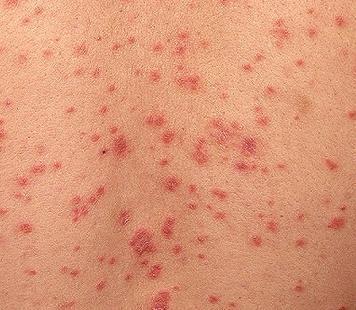 Tipi di psoriasi e fotografie - Psoriasi a gocce