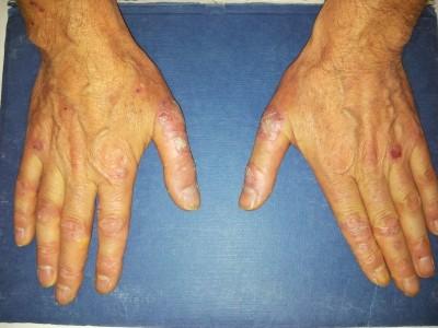 Tipi di psoriasi e fotografie - Psoriasi cronica stazionaria o psoriasi a placche (Psorosi vulgaris)