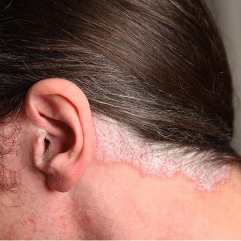 Tipi di psoriasi e fotografie - Psoriasi del cuoio capelluto