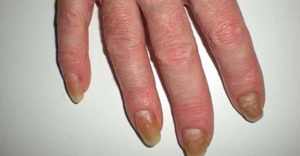 Tipi di psoriasi e fotografie - Psoriasi ungueale