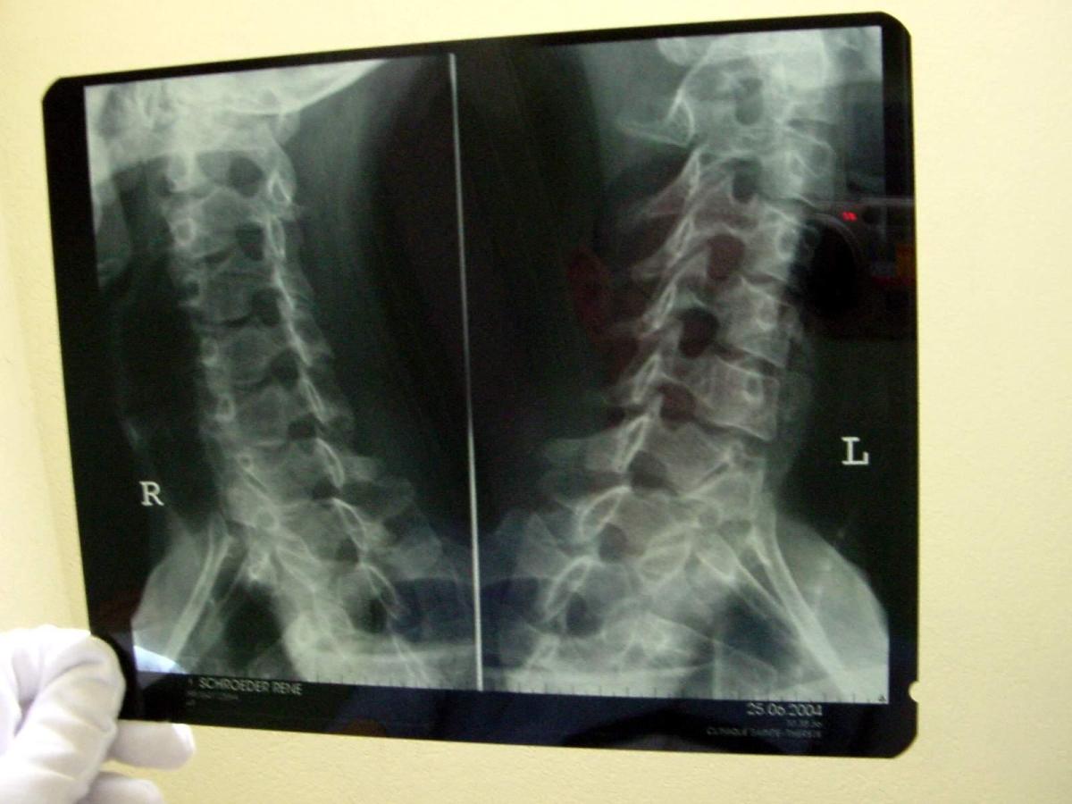 Come trattare una contrattura cervicale