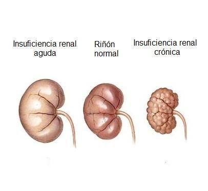 Quali sono i sintomi dell'insufficienza renale - Passo 2