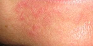 Come eliminare la tigna dal viso