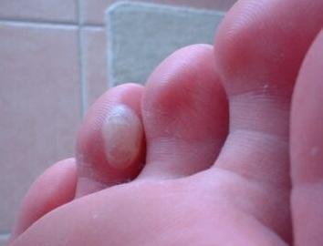 Come curare le vesciche su mani e piedi