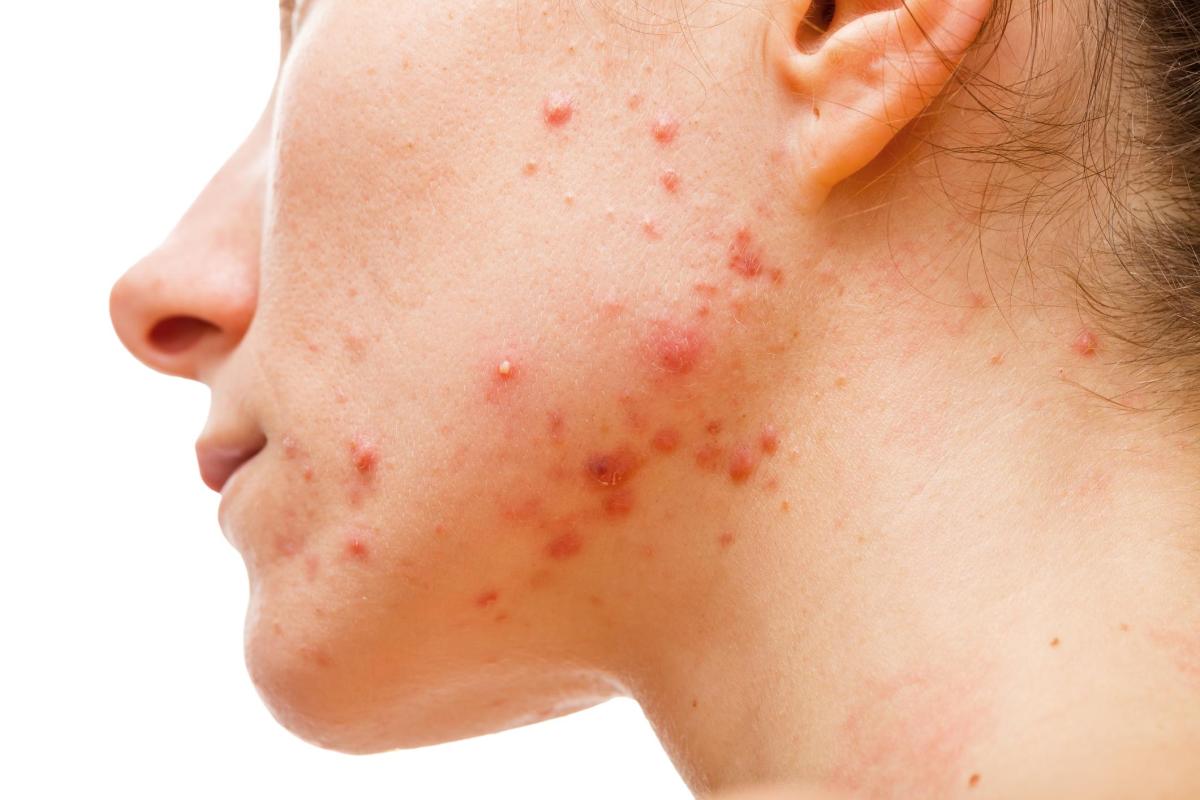 Rimedi naturali per l'acne veloci ed efficaci