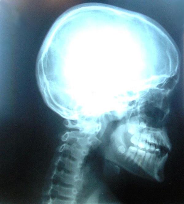 Cos'è l'osteofitosi
