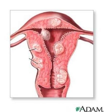 Quali sono i sintomi di un mioma uterino