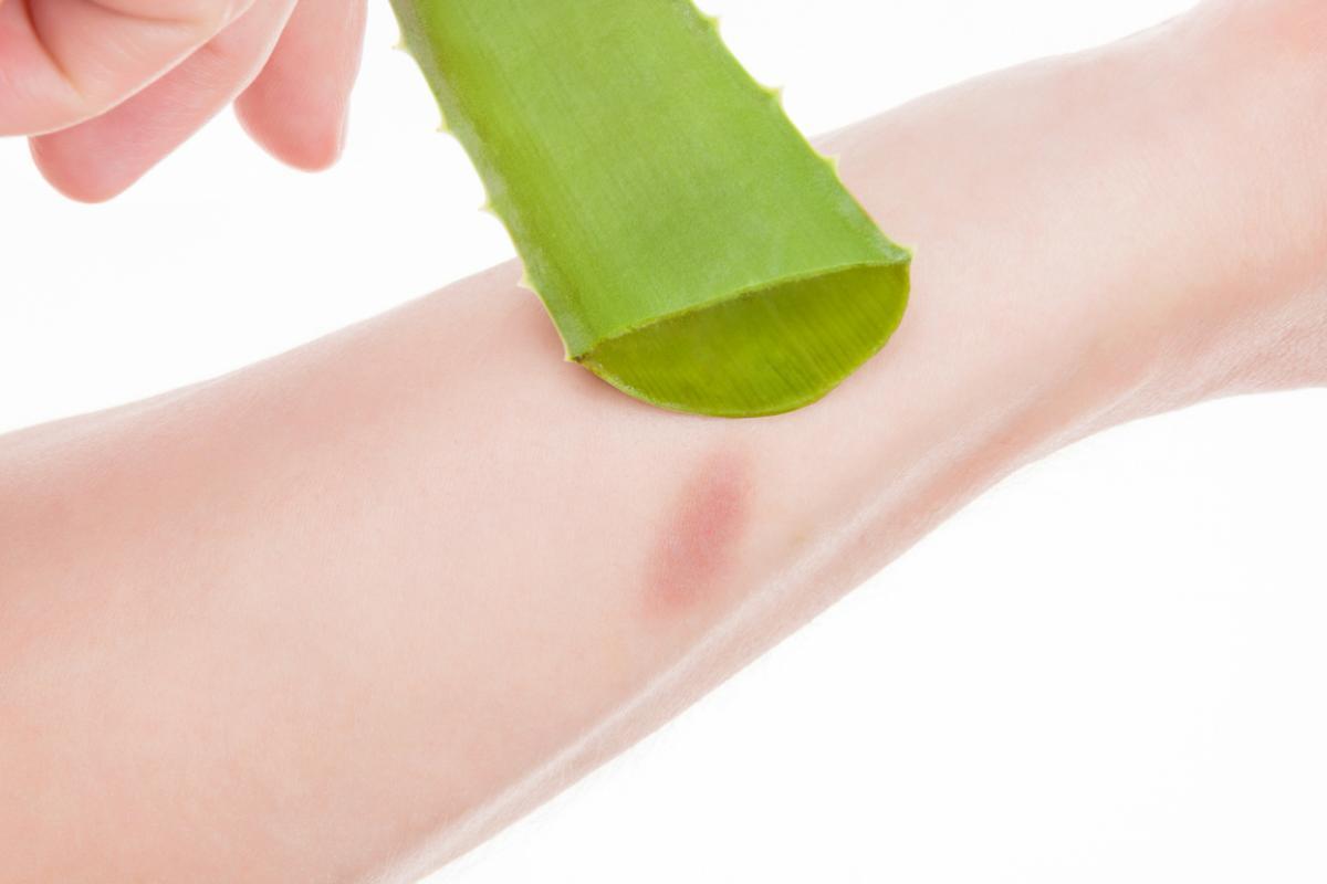 Come usare l'aloe vera per le scottature solari
