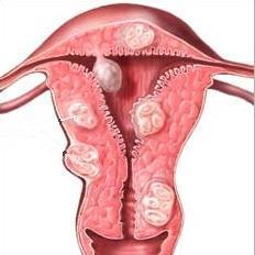 Come curare i fibromi uterini